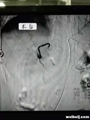 丽江首例！市人民医院两台“栓塞术”顺利完成