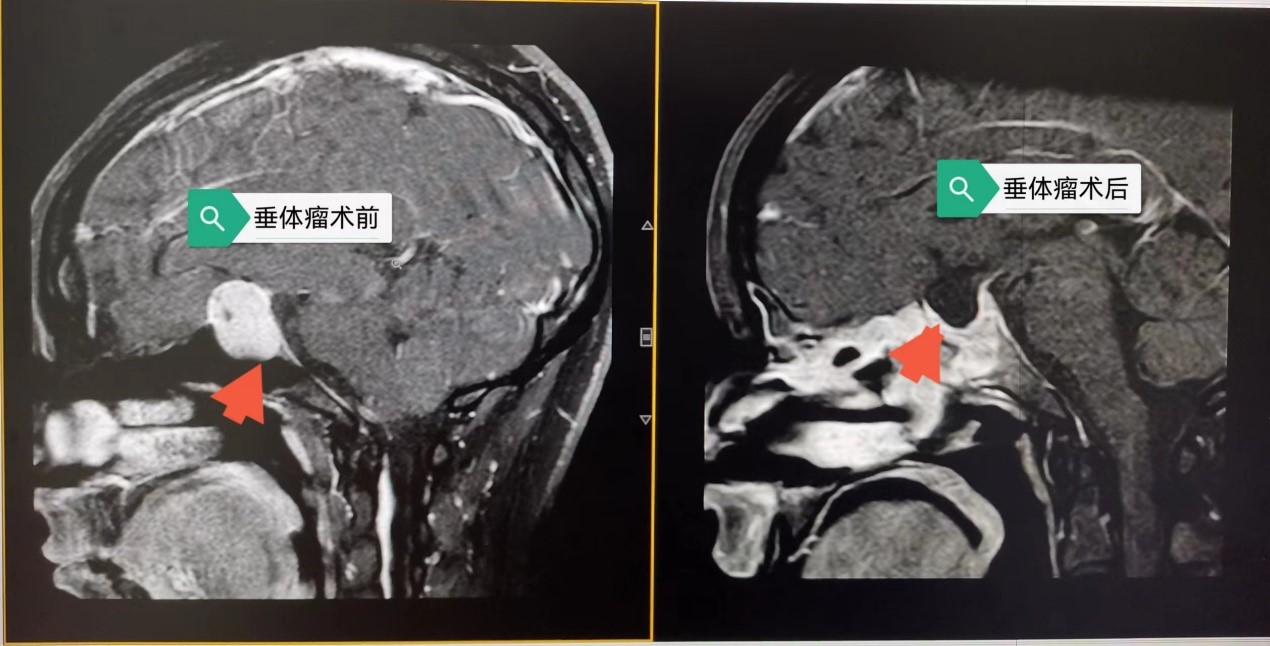 丽江市人民医院微创清除颅内垂体瘤 引领神经外科手术进入微创时代 (1).jpg