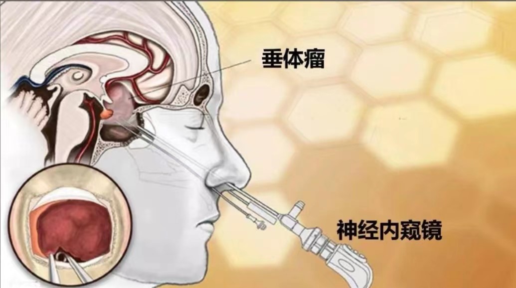 丽江市人民医院微创清除颅内垂体瘤 引领神经外科手术进入微创时代 (4).jpg
