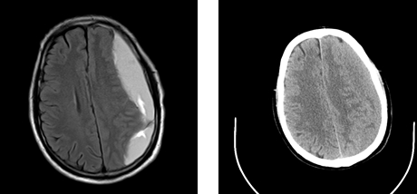 老人跌倒后不可忽视  丽江市人民医院成功救治一名慢性硬膜下血肿患者 (3).png